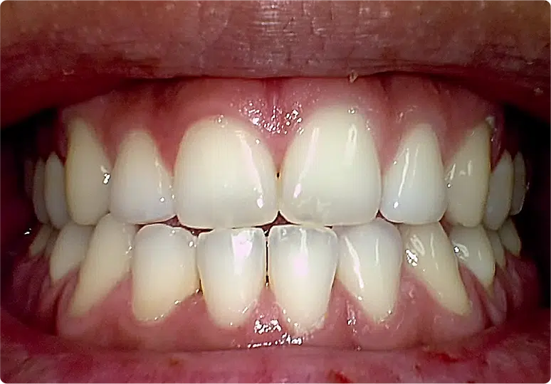 Sample intraoral photo captured with a Claris i5HD camera