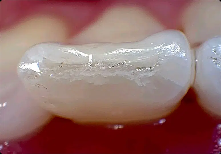 Sample incisor detail capture
