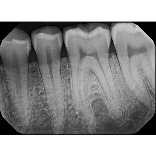 Sample lower posterior pa capture