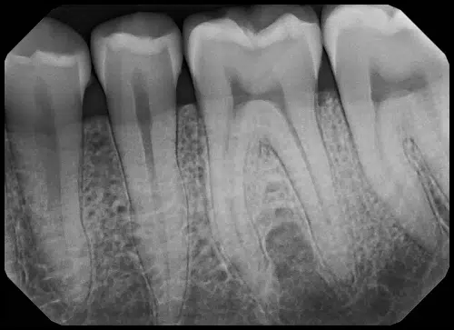 Sample radiograph captured with a Clio sensor